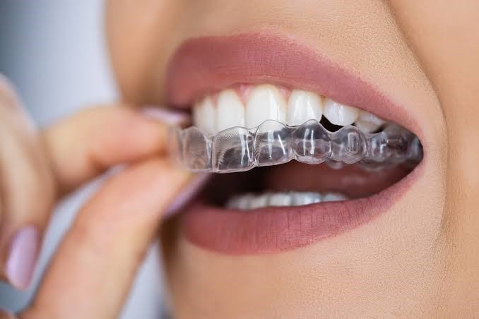 Clear Aligners Ahmedabad