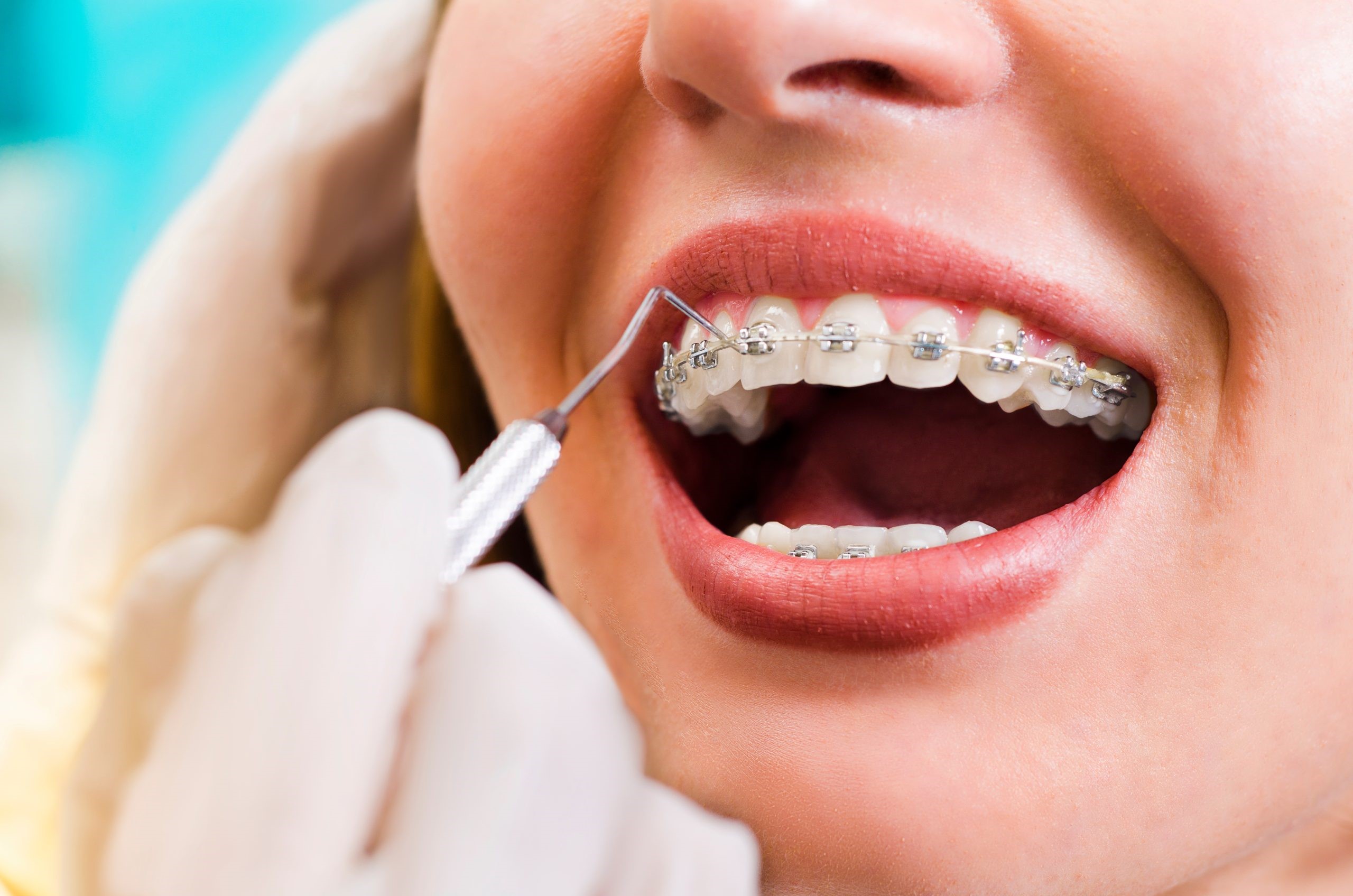 Braces Treatment Ahmedabad