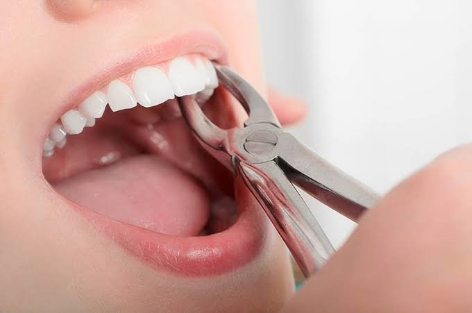 Tooth Extraction Ahmedabad
