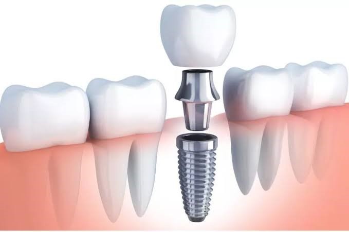 Dental Implants Ahmedabad