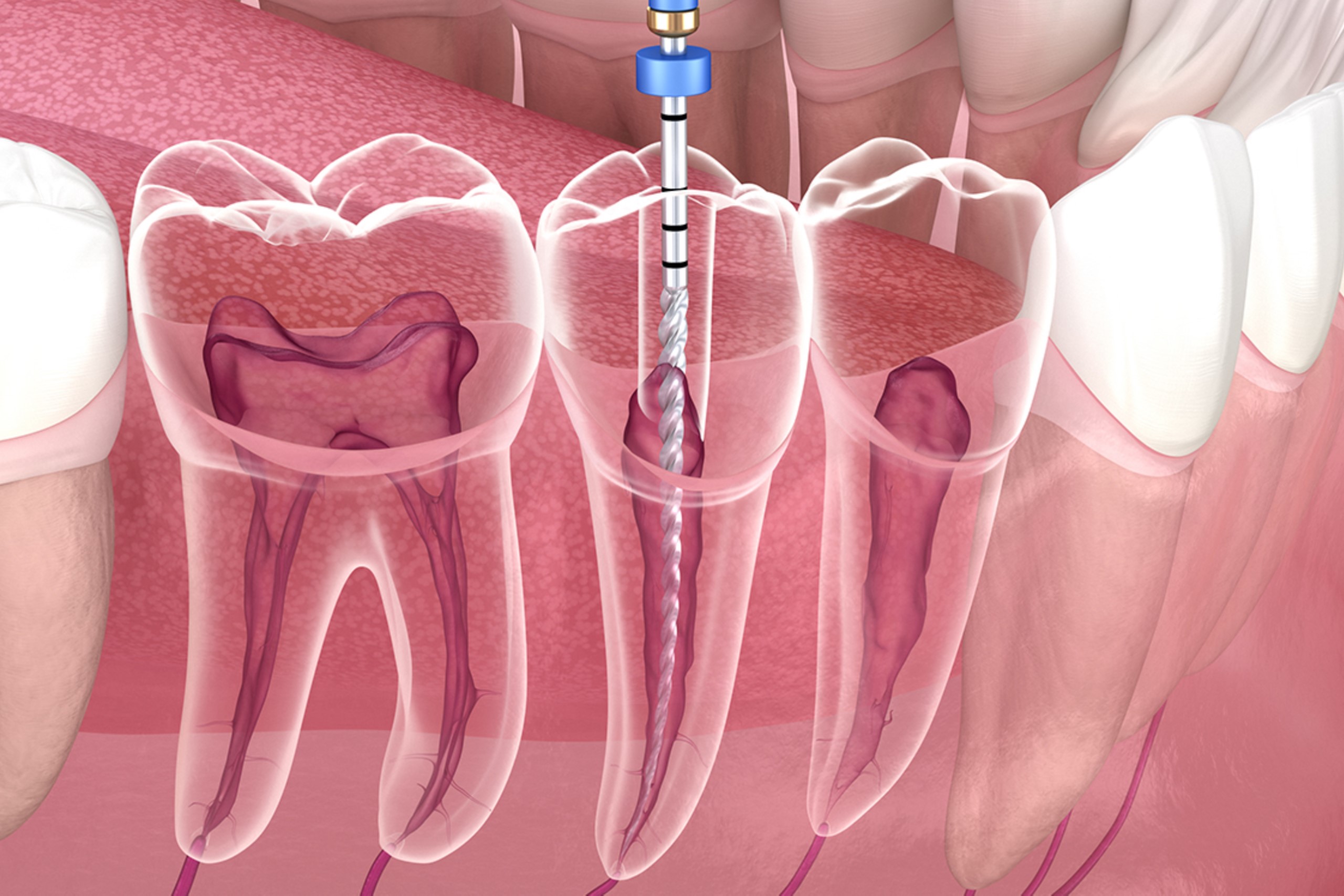 Root Canal Treatment Ahmedabad