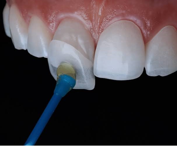 Dental Veneers Ahmedabad
